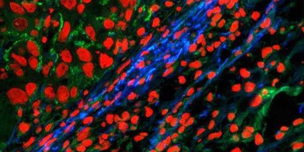 Fluoreszenzmikroskopiebild vom Tumorrand: Der Tumorrand ist mit dem neuen Marker-&#8203;Molekül blau gefärbt, oben links davon ist Tumorgewebe. Grün: Kollagen, rot: Zellkerne (ETH Zürich).