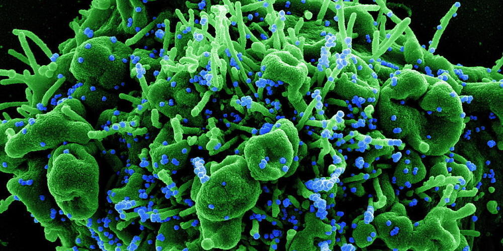 Mikroskopaufnahme einer menschlichen Zelle (grün), die mit Coronavirus-Partikeln (blau) infiziert ist. (Archivbild)