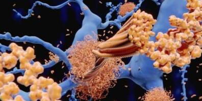Amyloid-Beta-Plaque in den Zwischenräumen von Gehirnzellen, wie es für Alzheimer typisch ist. Bei Fruchtfliegen mit dieser Beeinträchtigung linderten Schlaf- und Epilepsiemittel die Gedächtnisprobleme (Pressebild Uni Freiburg).