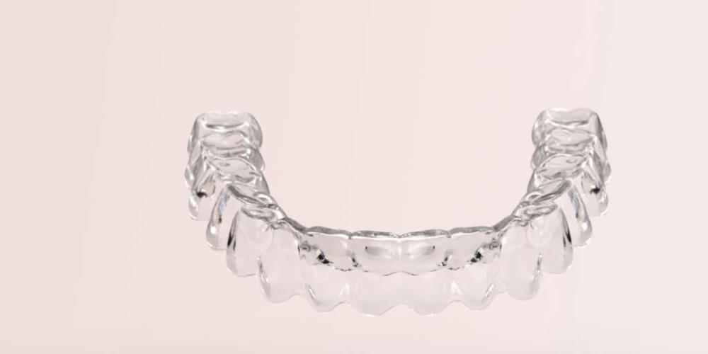 Die neue Migros-Tochter produziert "unsichtbare" Zahnspangen. (Bild Bestsmile)