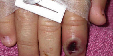 Laut WHO verbreitet sich das Affenpocken-Virus bereits seit Mitte April in Europa. Die Weltgesundheitsbehörde hat eine Warnung herausgegeben. (Archivbild)