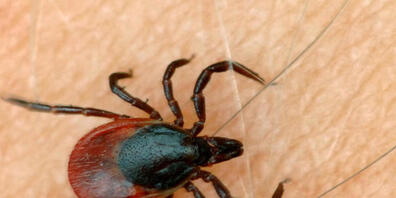 Die Borreliose wird durch ein Bakterium verursacht, das durch Zeckenbisse übertragen wird. Infizierte bekommen häufig einen Hautausschlag und leiden unter grippeähnlichen Symptomen. (Archivbild)