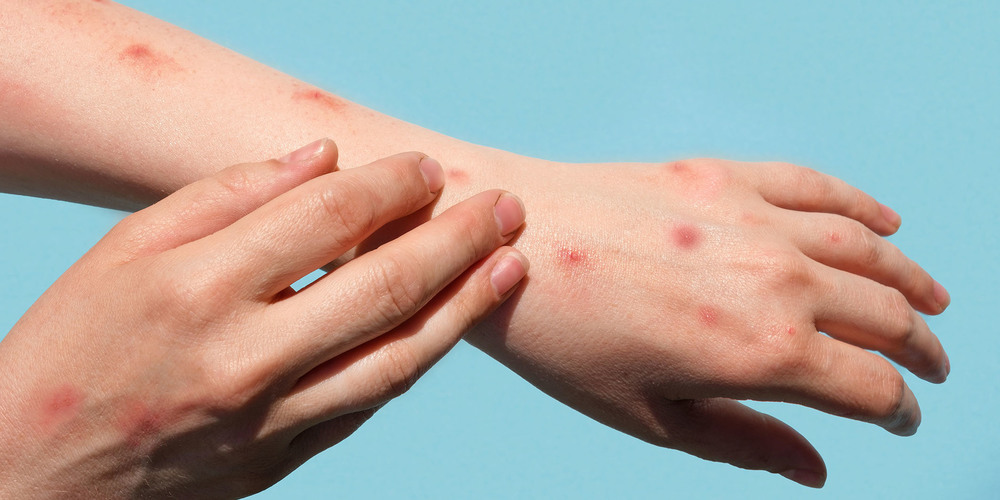 Schon vor dem Auftreten von Symptomen kann das Affenpocken-Virus weiter übertragen werden.
