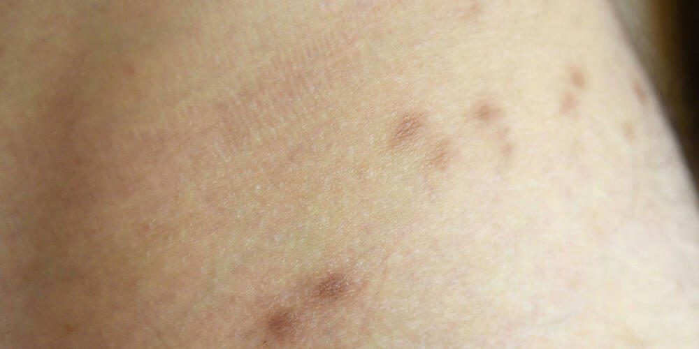 In der Schweiz besteht aktuell keine Meldepflicht für Krätze, fachsprachlich Scabies genannt. Im Bild Narben nach einem Krätze-Befall. (Symbolbild)