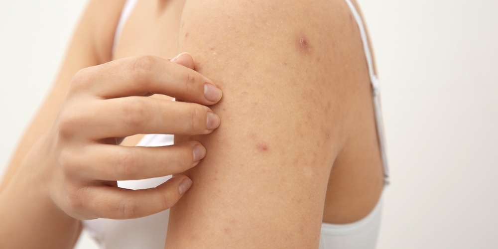 Scabies (Krätze) ist eine ansteckende Hauterkrankung, die durch die Krätzmilbe hervorgerufen wird.