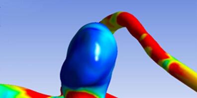 Aneurysmen sind Ausbuchtungen an Blutadern. Forschende haben nun 17 Gene identifiziert, die mit deren Bildung zusammenhängen.