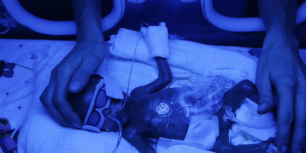 Ein frühgeborenes Baby, das auf einer Intensivstation mit Blaulicht bestrahlt wird: Eine Studie zerschlägt die Hoffnungen, dass die Gabe des Hormons EPO den Frühchen hilft.