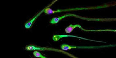 Gesunde Spermien. Bei Männern, die an Covid-19 erkrankt sind, ist die Konzentration weniger dicht, viele Exemplare sind schlechte Schwimmer, manche haben Deformationen, wie Forscher herausgefunden haben. (Symbolbild)