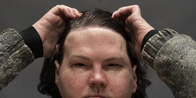 Joe DiMeos Gesicht war nach einem Brandunfall nur noch eine Ansammlung von Narben und seine verklumpten Hände waren nicht mehr zu gebrauchen. Plastische Chirurgen in New York haben ihm das Gesicht und die Hände eines Spenders transplantiert.