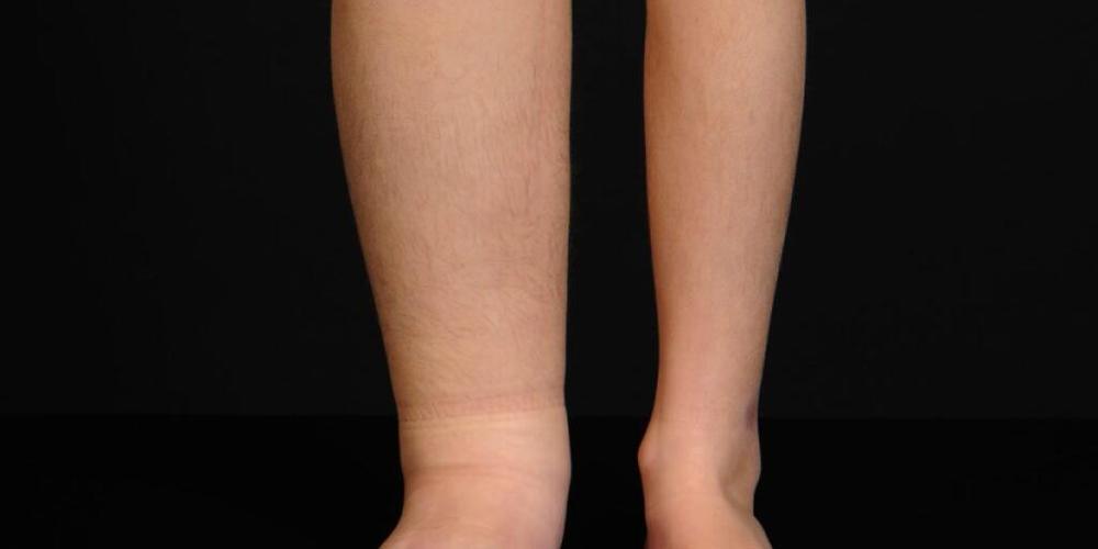 Lymphödem bei einem Kind. Normalerweise wird es mit Kompression oder Drainage behandelt - vorübergehend. Prof. Nicole Lindenblatt vom Kinderspital Zürich hat nun erstmals in der Schweiz einen Lymphknotentransfer an einem Kind durchgeführt, um das ...