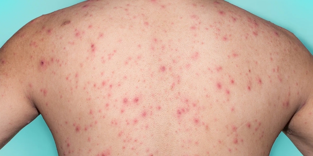 Nach mehreren Fällen von Windpocken im Asyl-Durchgangszentrum in Adliswil wird der Impfstatus von rund 200 Kontaktpersonen überprüft. (Symbolbild)